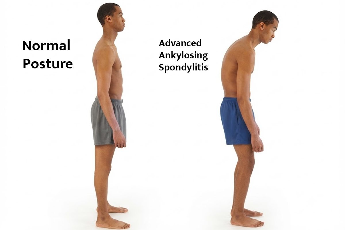 Spondylitis Spectrum Disease