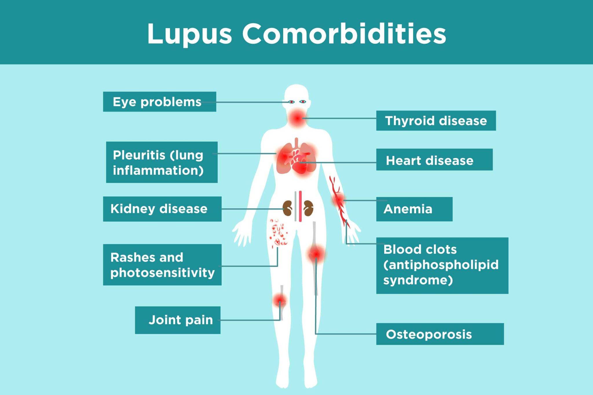 Autoimmune Diseases